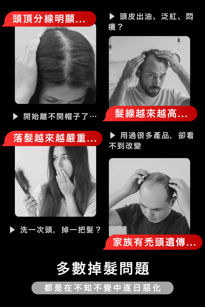 頭頂分線明顯, 髮線越來越高, 落髮越來越嚴重